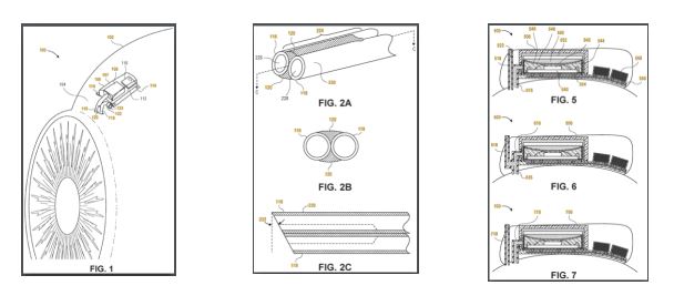 Today's Patent - Implantable Extracompartmental pressure sensor